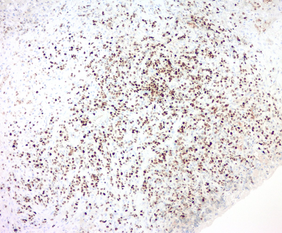 jake_bledsoe's tweet photo. What is your differential and favored diagnosis for this biopsy of a large soft tissue mass? IHC: CD20 (left), cyclin D1 (right). #hemepath #pathology https://t.co/JL174i5VZ2