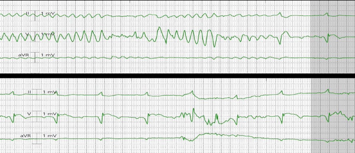 hcmcEM's tweet photo. Treating a puking patient on methadone is a recipe for disaster. This patient went into torsades on the way to CT after zofran admin, spontaneously resolved. Repeat ECG shows 2nd degree type 2 AV block with junctional escape rhythm vs CHB. @smithECGBlog https://t.co/34IxJkQasQ