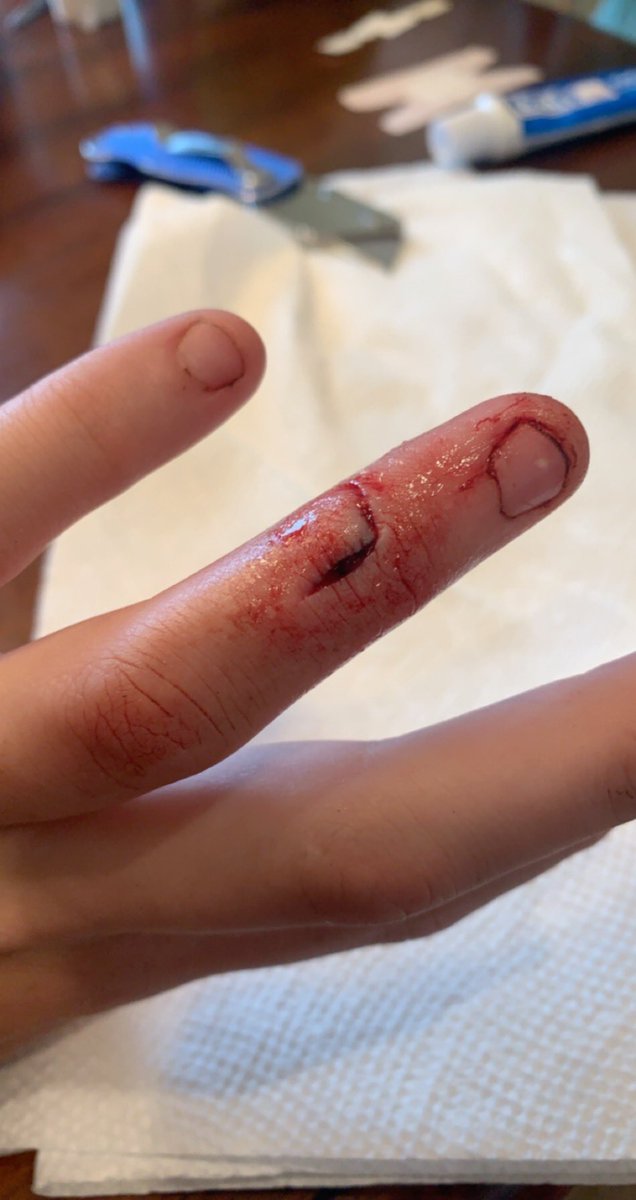 EngramTaylor's tweet image. Worst pain I have ever felt so far, after two rounds of super glue