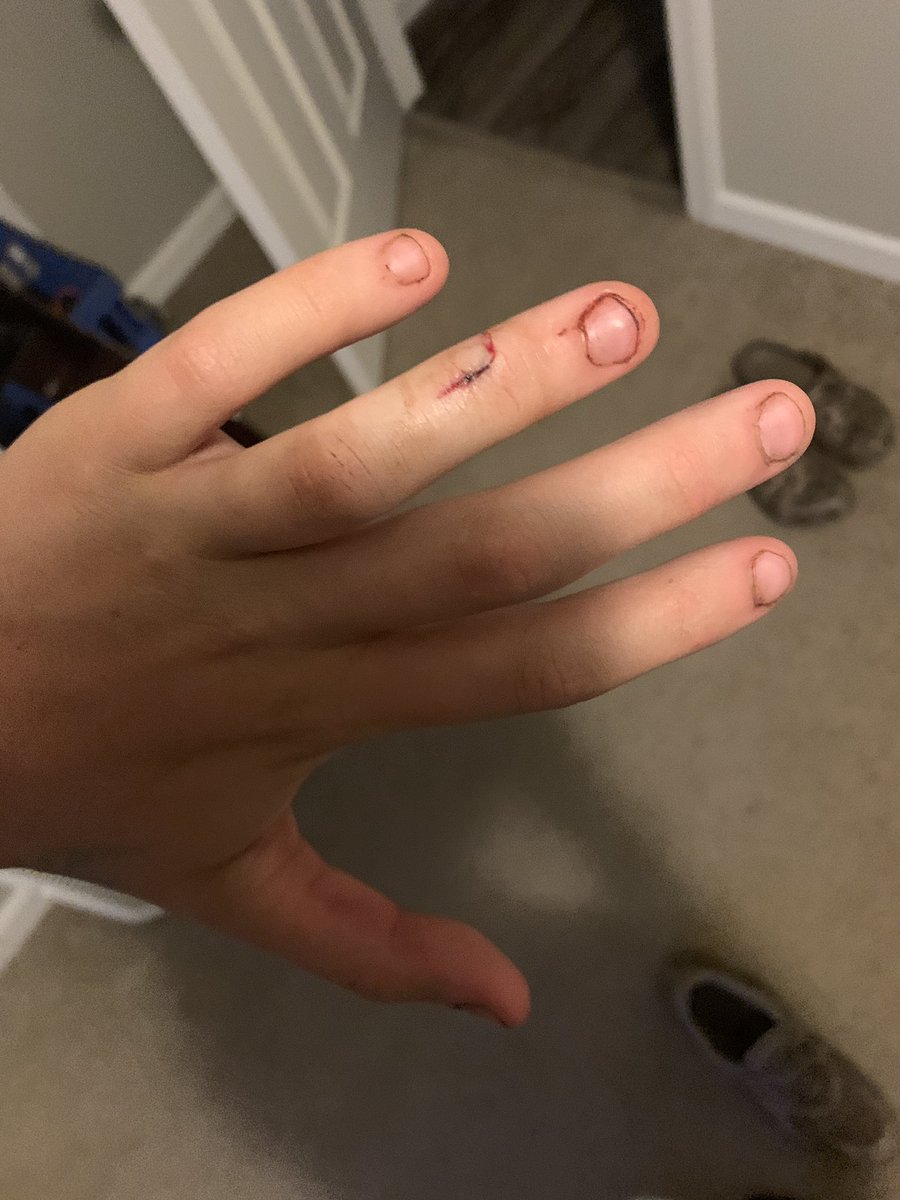 EngramTaylor's tweet image. Worst pain I have ever felt so far, after two rounds of super glue