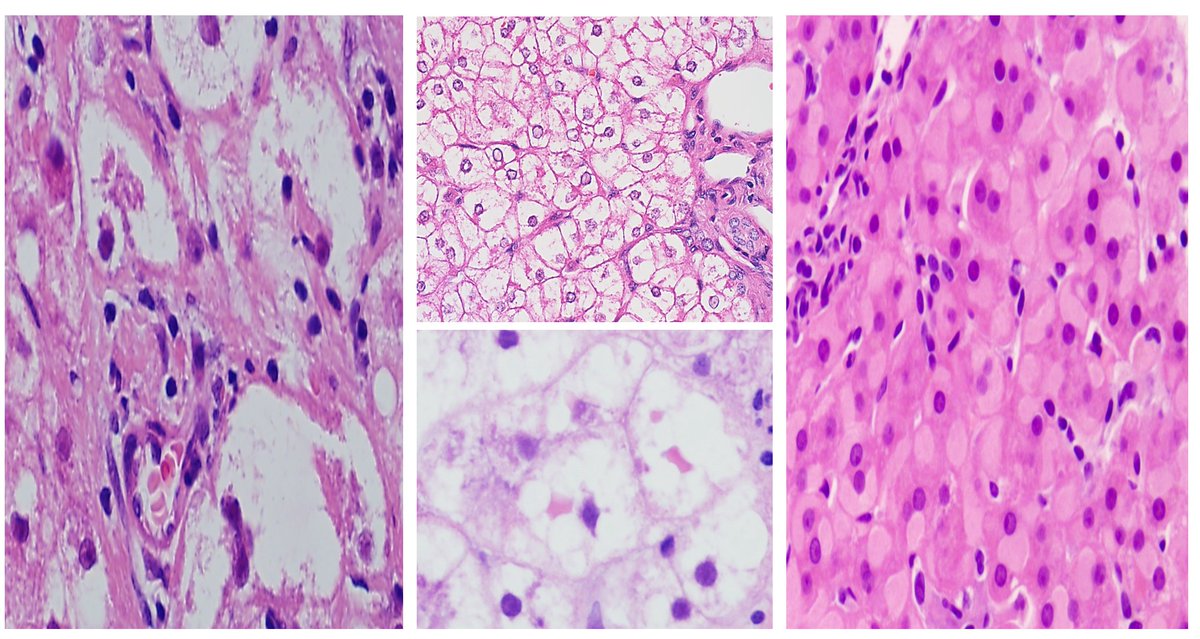 NigarAKhurram's tweet photo. Case 142: Acute hepatitis and the role of a pathologist https://t.co/iQYnTD7pUP