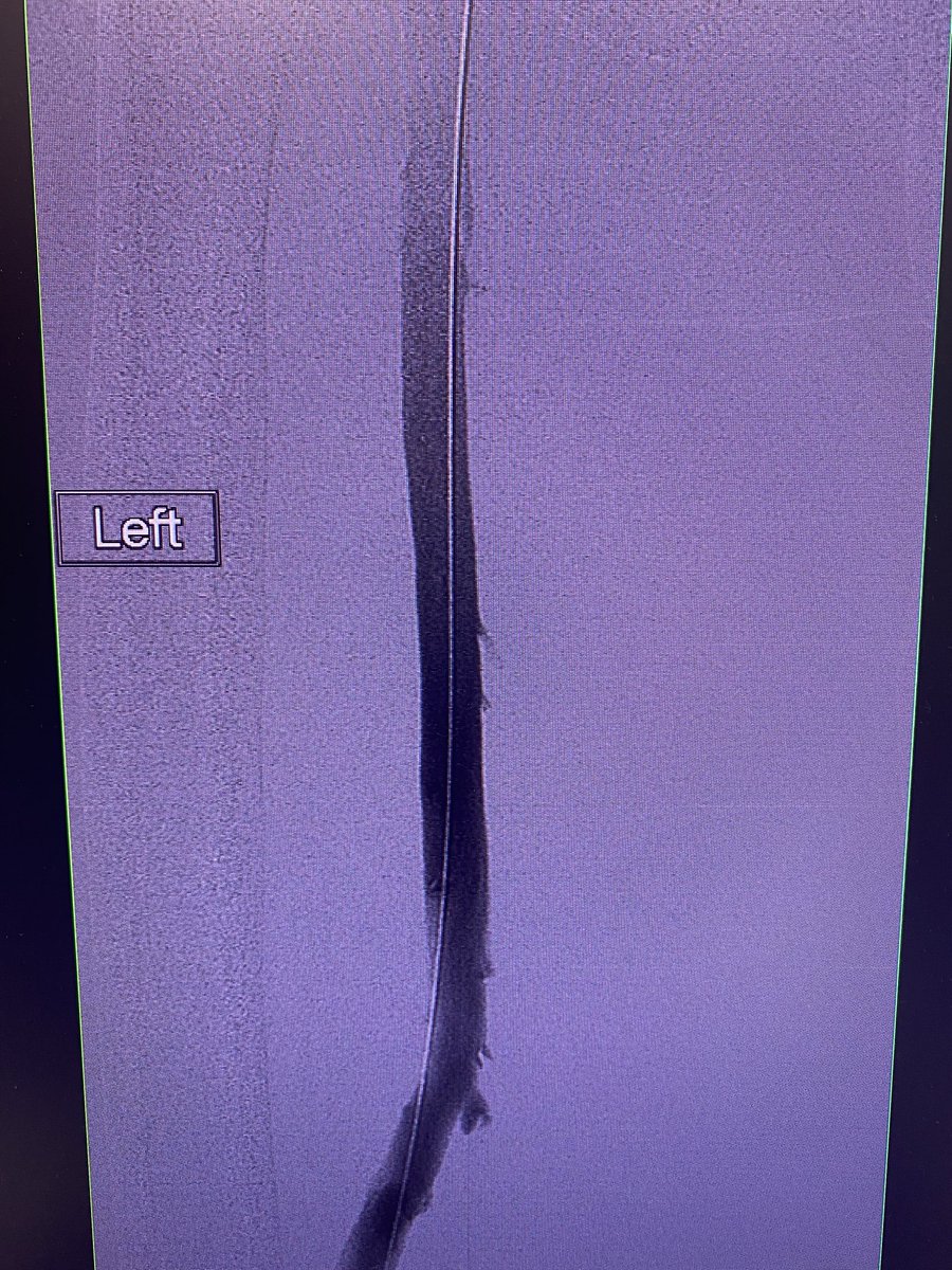 There are so many more options for thrombectomy now, especially for no-TpA patients: RCC with IVC occlusion and acute DVT to the pops. Clottriever with restoration of flow @SIRRFS