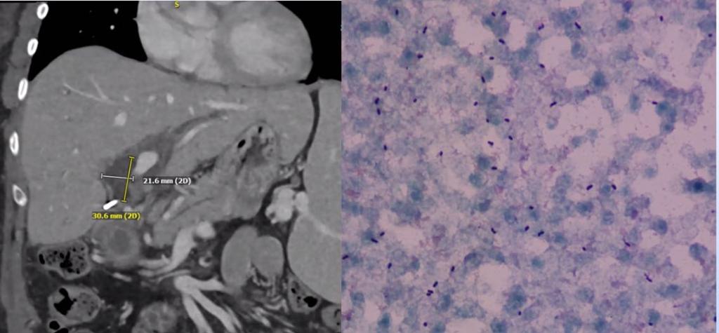 MayoClinicINFD's tweet photo. #MayoIDFellowship Tri-site Conference
4 weeks after liver transplant, a patient developed fever. Abdominal image: liver fluid collection. Blood culture: Gram positive cocci/ coccobacilli / short rods (photo). Empiric Rx Vancomycin, ceftazidime, metronidazole #MayoIDQ MCQ next https://t.co/jZaDfUaW1E