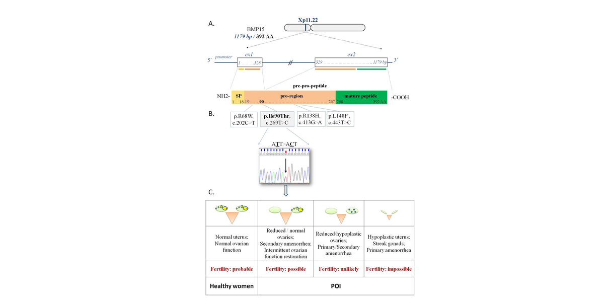 CEOGjournal's tweet photo. A rare BMP15 genetic variant in a patient with #premature ovarian insufficiency and two spontaneous pregnancies https://t.co/54fAKM4fjK #fertility #BMP15 genetic variants https://t.co/u1U92FZa5D
