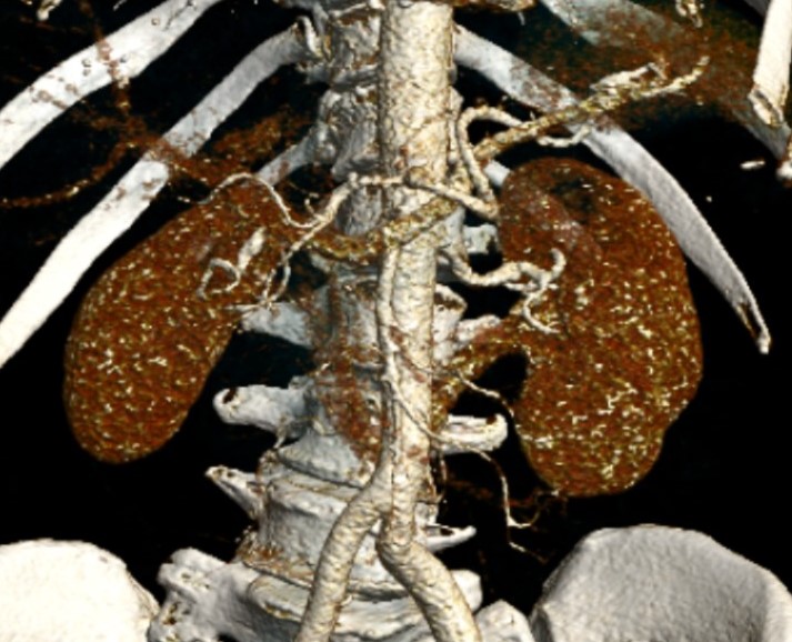 We solve surgically over 200 cases of kidney tumours per year. Following 1000 open and 600 laparoscopic kidney tumour resections, we have started this week programme of robotic resections. Never more laparoscopy. Open for highly complex cases - now, in future? #uroczech