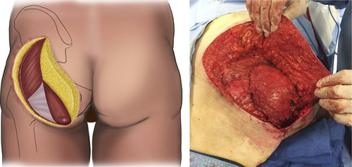 Dual-Plane Gluteal Myocutaneous Flap for Reconstruction of Ischial Tuberosity Pressure Wounds shorturl.at/muCJN
#surgery #plasticsurgery #reconstruction