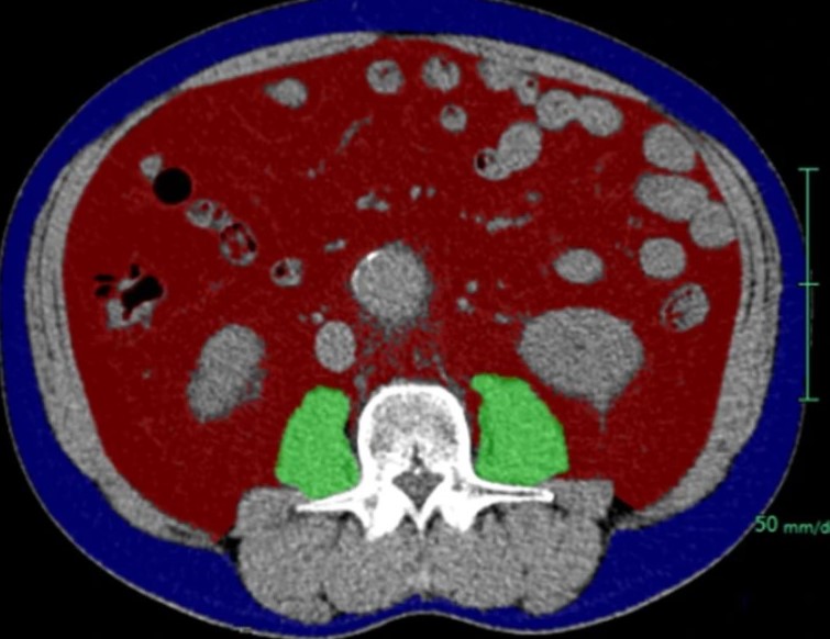CVIR_Journal's tweet photo. Risk of Psoas Muscle Atrophy After Endovascular Aneurysm Repair Assessed by Cross-Sectional Psoas Muscle Area | https://t.co/DbhHSzz64x
#psoasmuscle https://t.co/EANjyEVPt2