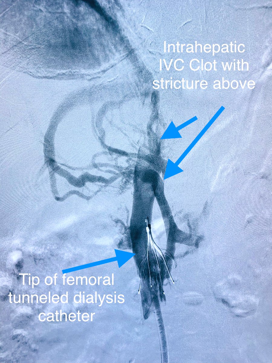 t_intheleadcoat's tweet photo. #ESRD on #HD for years, referral for non-functional femoral #tunneled catheter.
#Venogram catheter tip at #IVCfilter, #Clot above filter, intrahepatic IVC occlusion.
Known upper #CVO.
What would you do for access short & long term? #IRad @dialysisnetwork @SIRRFS @ASNKidney https://t.co/Wlc8ERjslK