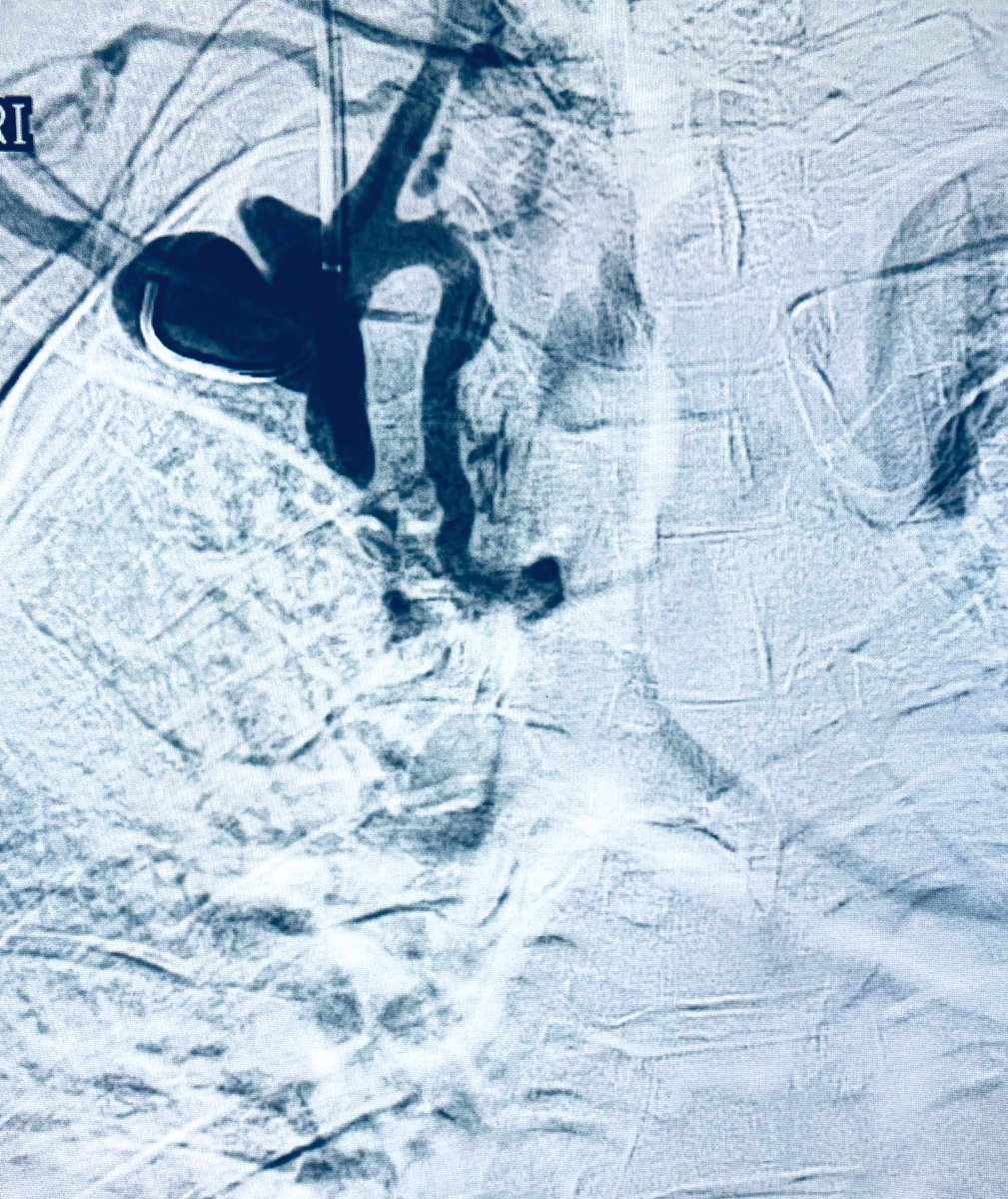 t_intheleadcoat's tweet photo. #ESRD on #HD for years, referral for non-functional femoral #tunneled catheter.
#Venogram catheter tip at #IVCfilter, #Clot above filter, intrahepatic IVC occlusion.
Known upper #CVO.
What would you do for access short & long term? #IRad @dialysisnetwork @SIRRFS @ASNKidney https://t.co/Wlc8ERjslK