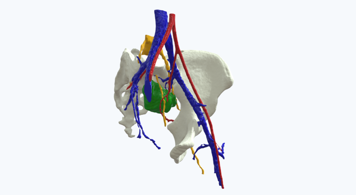 Axial_3D's tweet image. Read on our blog about how having access to a 3D anatomical model helped the surgeons in this case to have dramatically enhanced insights into the patient’s autonomy and pathology. buff.ly/3hL4o2U

#medical3Dprint #3Dprinting #anatomicalmodel #preopplanning #patientcare