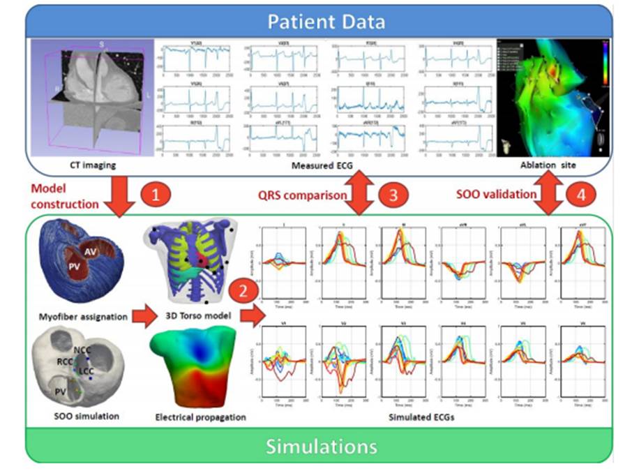 UPFBarcelona's tweet photo. #UPFresearch
Patients with ventricular tachycardia may benefit from computer modelling to plan their treatment
👉https://t.co/dbFDs3QcpC @BCN_MedTech https://t.co/FBrdFOcX2W