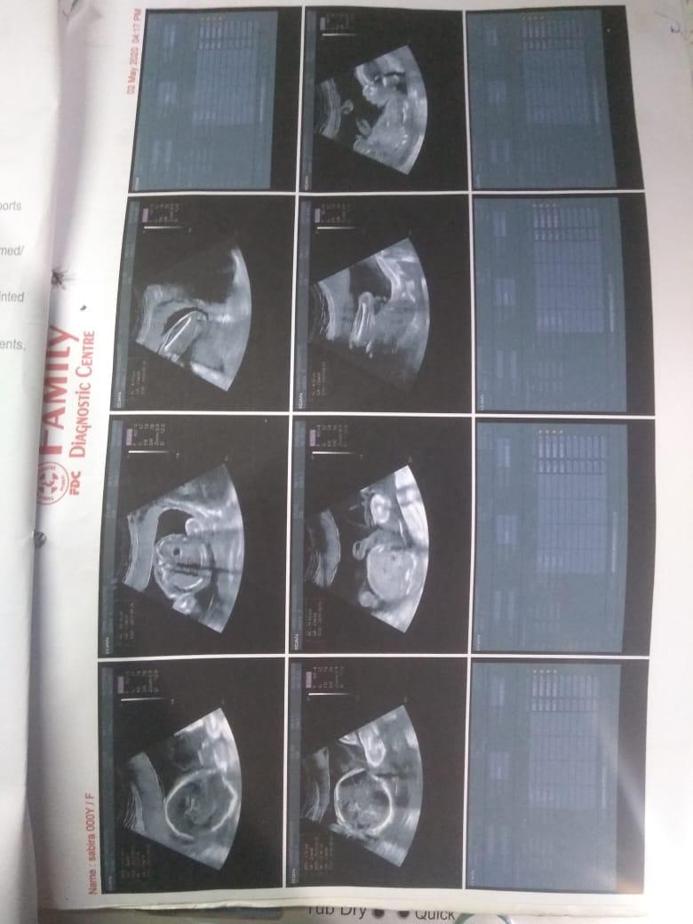 x05409's tweet photo. https://t.co/JFWiLAaESd
The sister shall be going through a C-sec to deliver her twins within 15 days.Her husband has no job due to lockdown & they have no means to support her hospital & medicine expenses. Target is 60k. Help her & her twins by donating to our cause. DM for info https://t.co/fd9TZOayRs