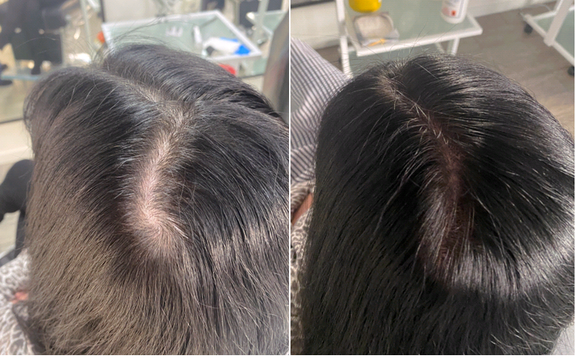 Look at these amazing before and after shots from our #scalpmicropigmentation This subtle treatment replicates the natural appearance of real hair follicles, giving you the appearance of a full head of hair.