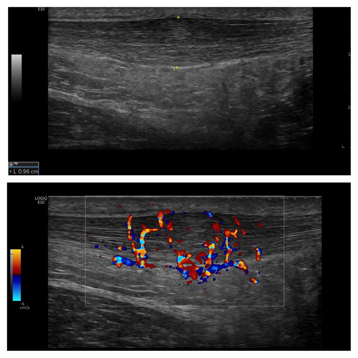 Seeing more patients <a href="/one_welbeck/">OneWelbeck</a> with painful, mid-portion Achilles tendinopathy, on a background of rapid increases in high impact load/running during lockdown. Images show thickened tendon (9.6mm diam) with florid neovascularity. GE logic E10 🏃🏽