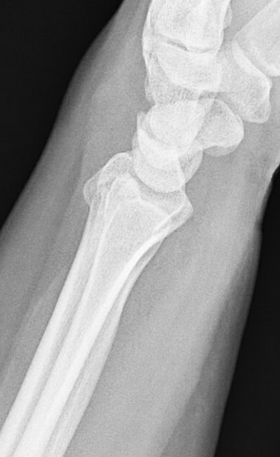 24y/o healthy RHD F who works in an office job fell roller skating.Nothing surprising on exam @DKennedyHands  @DrewAlbertMD  @handz98  @maximhorwitz  @hunter_alistair  @TJQPNI  @HolliePowerMD @Orthofacts  @JuncturaTheorum  @CY_Hand  @hand_specialist  @elveymichael  @m_lane19  @ChrisDyMD