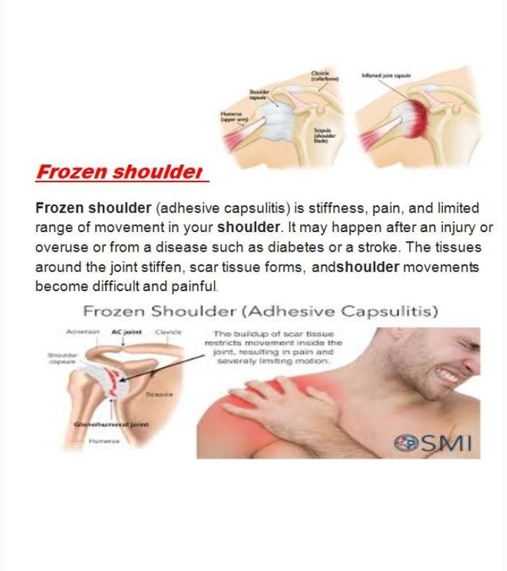HPA_Pakistan's tweet photo. #shoulder #frozenshoulder #mobility #stiffness #injur #rotatorcuff #fitnessmodel #shouldersurgery #shouldermobility #physicaltherapy #hpa #hpateam #hpawork https://t.co/ZBPbyFqDK2