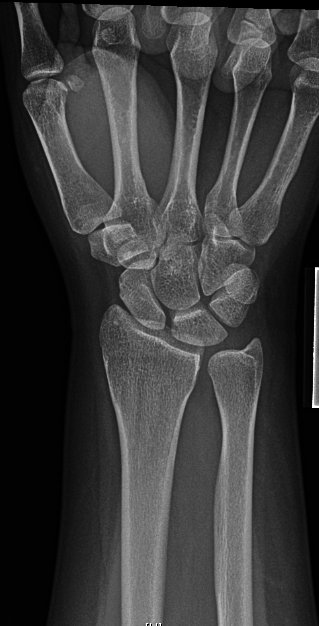 Given frx pattern and risk for concomitant SL injury (and ?SL widening), started scratching the ole’ noggin.Couldn’t do dynamic (grip) view for injured side so we went for a contralateral comparison. Subtle differences if any…Now what? Some voting for CT or MRI...
