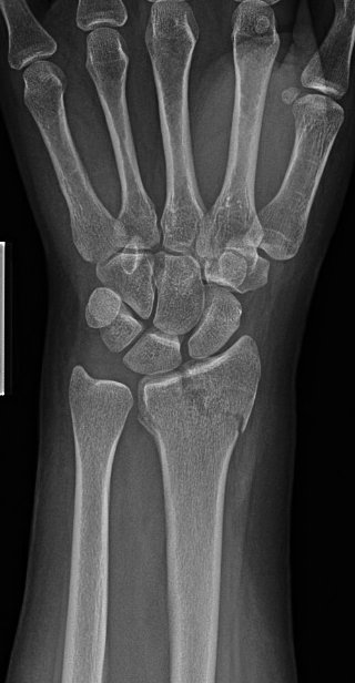 Given frx pattern and risk for concomitant SL injury (and ?SL widening), started scratching the ole’ noggin.Couldn’t do dynamic (grip) view for injured side so we went for a contralateral comparison. Subtle differences if any…Now what? Some voting for CT or MRI...