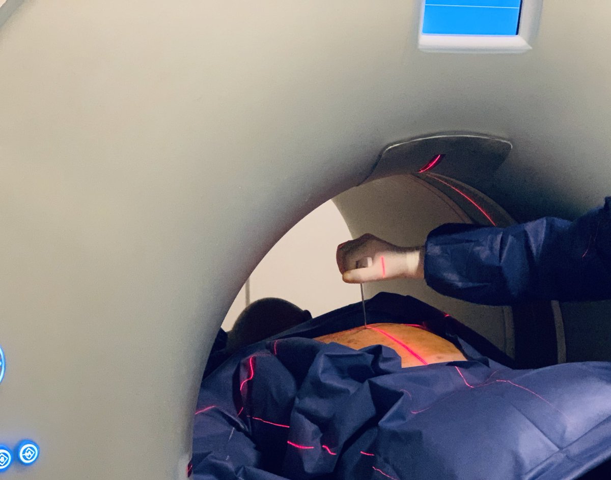 SUHAIBa2t's tweet photo. percutaneous CT-guided vertebral body core biopsy, transpedicular approach. 
#withoutascalpel
#interventionalradiology
#interventional2
#pairsmedia
#pairsweb https://t.co/pqA6m5xMrq
