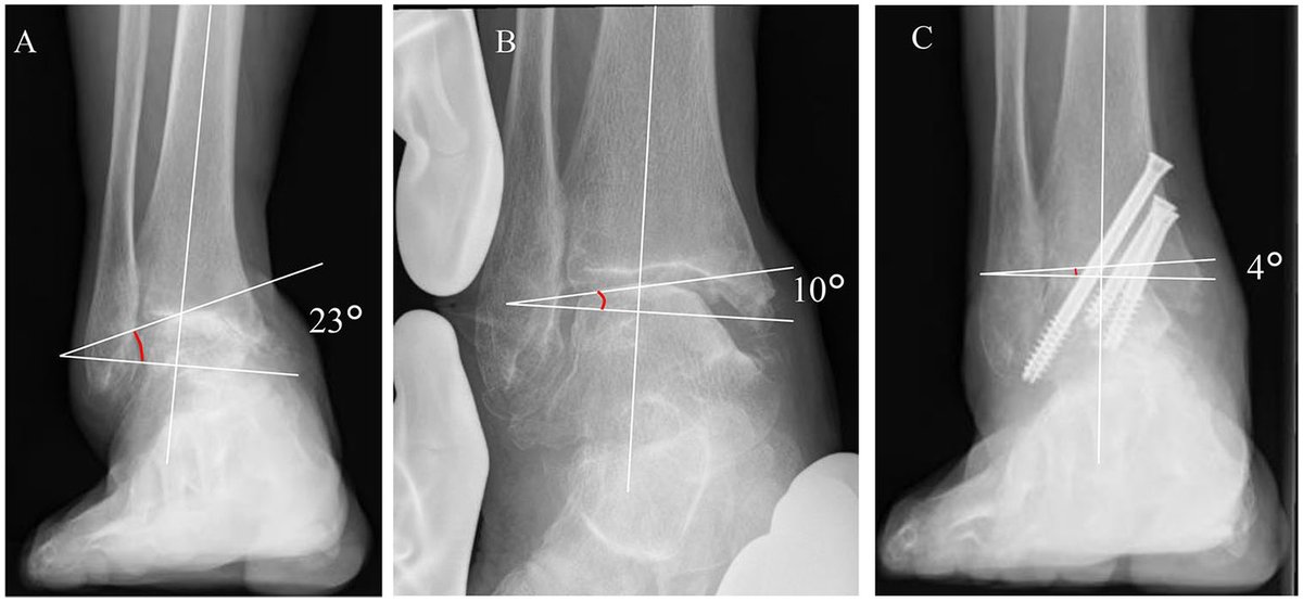AOFAS_Journals's tweet image. This study emphasized the increased prevalence of lateral gutter osteophytes in moderate-to-severe varus deformity end-stage ankle arthritis patients and the importance of osteophyte resection in deformity correction during arthroscopic arthrodesis. ow.ly/XHqD50AuZ0B