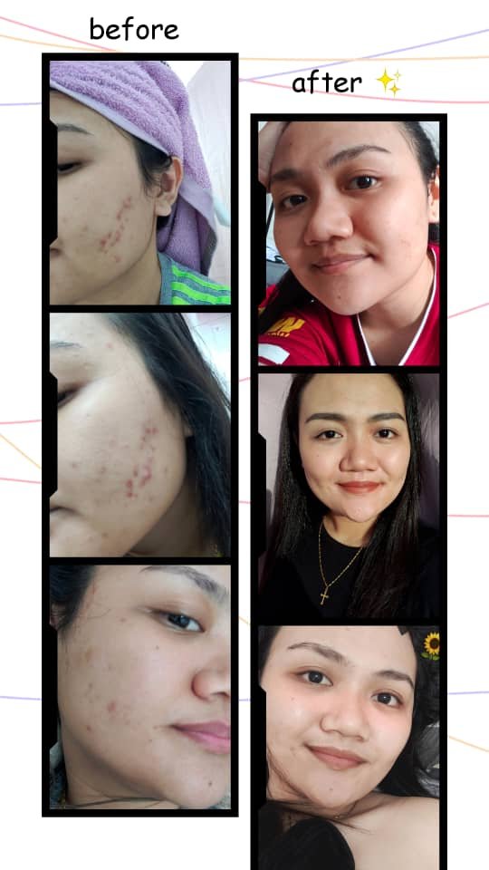 bougasbeautyHQ's tweet photo. Alhamdulillah, #advancedserum dah bantu ramai org yg ada masalah breakout. Jerawat ni mmg normal tp tak normal kalau kita tak take action utk rawat jerawat ni. Start now or cry later. https://t.co/bf1RigQLww