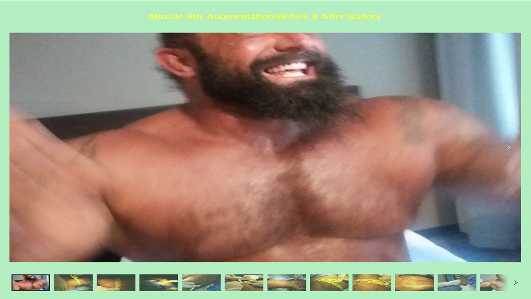 SurgeryLife's tweet photo. #SurgeryLifeEnhancement's #MuscleSiteEnhancement #Before &amp; #After gallery to watch BIG D's #muscles transform from 14" to 20" #biceps with #SLE #medical-#grade #LinneaSafe® #PMMAinjections!

https://t.co/FGGpkRauR4 — in Tijuana, Baja California. https://t.co/qwB799ySTY