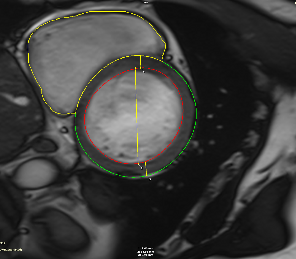 The convention in  #whyCMR is to measure the LV linear dimensions in the slice distal to the MV as shown below which was 6.7 cm, consistent with the patient's LV volumes which were the severe range.