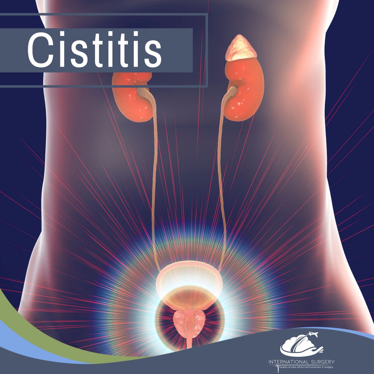 InternSurgery's tweet photo. Es una infección de la vejiga o las vías urinarias inferiores. Aguda significa que la infección comienza de manera súbita.

Causas
La cistitis es causada por microbios, por lo regular bacterias. Estos… https://t.co/fynlxAvNhX… https://t.co/IVUK6fm4di