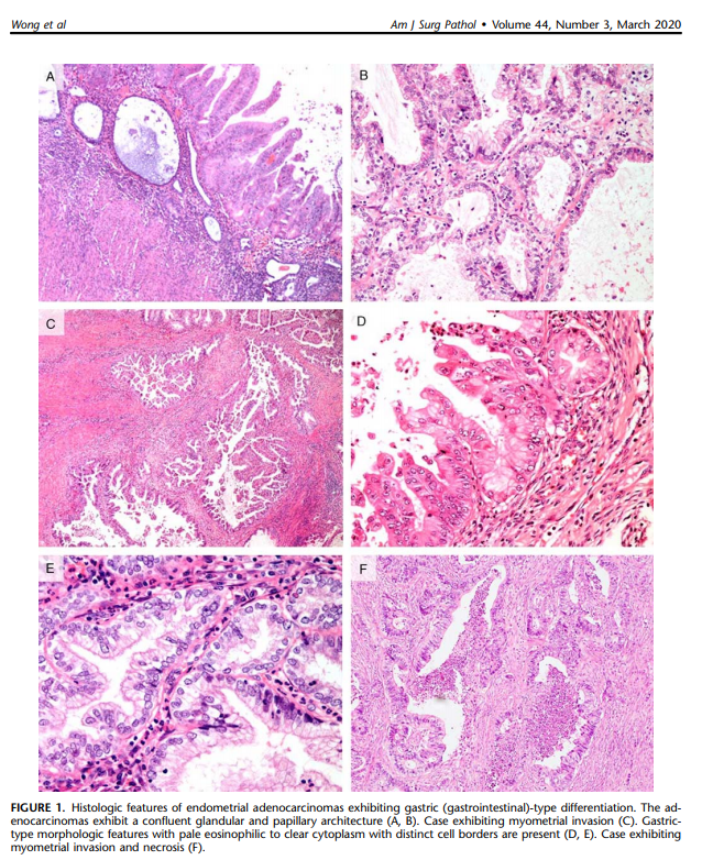 Very interesting new concept of gastric-type ENDOMETRIAL adenocarcinoma!
tl/dr:
journals.lww.com/ajsp/FullText/…

discovered with @orbitcme for @pathologycast. Earn SAM for this article at orbitcme.com/join/pathcast

#pathcast #gynpath #obgynpath #obpath #perinatalpath #placentapath #pocpath