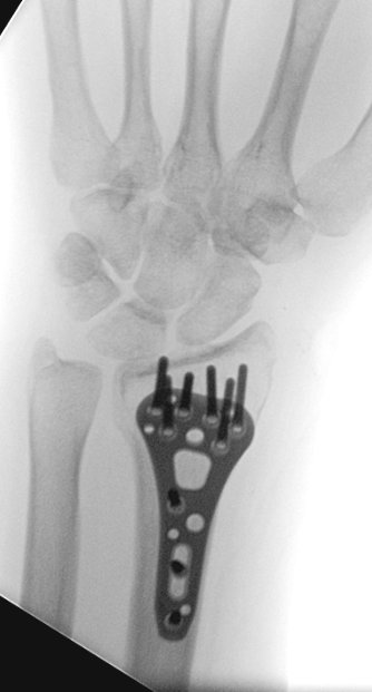 Pulled pins 6 weeks later and started motion. Bit of stiffness but overcoming that. Did we do too much? Was there  #value and  #quality in what we did? The early follow up is ok, but how would you have done it differently?