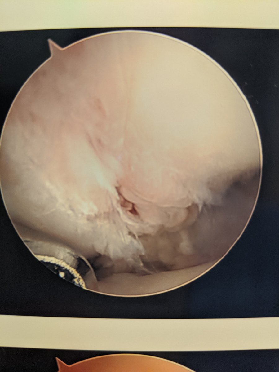 Of course, the scope tower saved whichever images it felt like. Membranous SL tear, no drive through, no shuck.