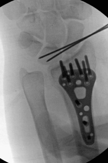 Scope assisted reduction of the articular surface was pretty cool, but radiographs honestly showed the same storyOrdinarily, I’d change that long/distal screw out, but since I was scoping the joint and didn’t see penetration, I felt ok leaving itDebrided and pinned the SL