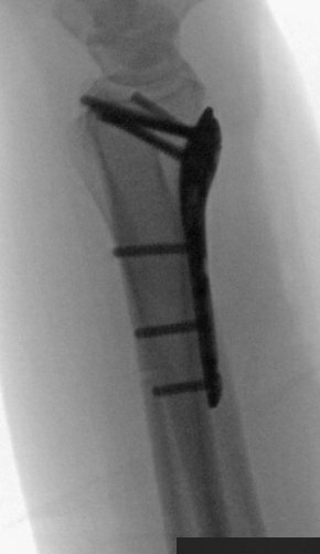 Scope assisted reduction of the articular surface was pretty cool, but radiographs honestly showed the same storyOrdinarily, I’d change that long/distal screw out, but since I was scoping the joint and didn’t see penetration, I felt ok leaving itDebrided and pinned the SL