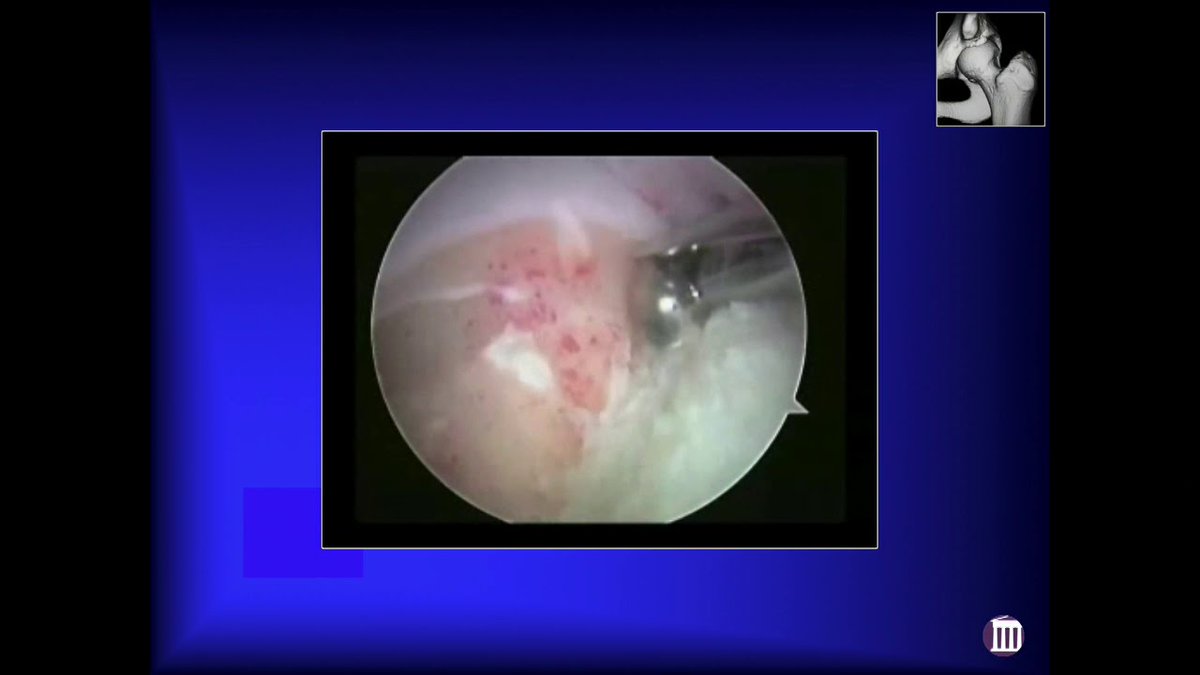 nashvilleorthos's tweet photo. In this video, Dr. Byrd discusses young athletic #hipproblems. When initially beginning to restore the labrum, the issue of FAI was not typically addressed. As time went on, it was clear that addressing the FAI was important to fixing issues w/the labrum. https://t.co/NAJmNBcIPb https://t.co/5WfipsTw80