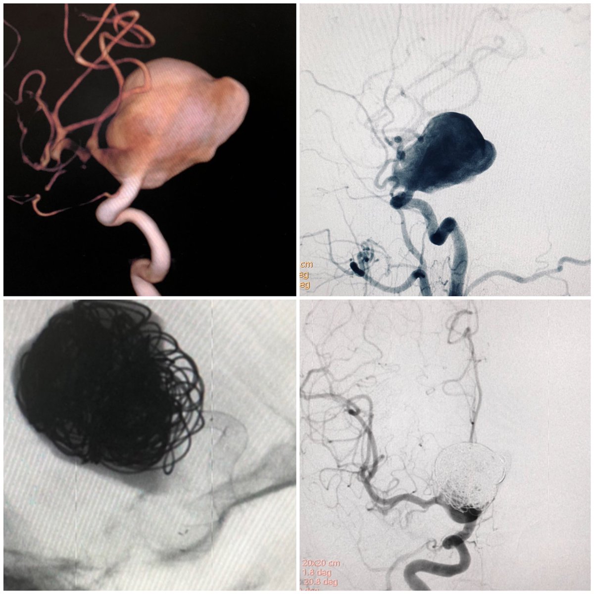 GNakiri's tweet photo. Closing out the week with a giant aneurysm treated with coils + flowdiverter. Let’s go home @neuroabud. https://t.co/ZLb8W0SDbv