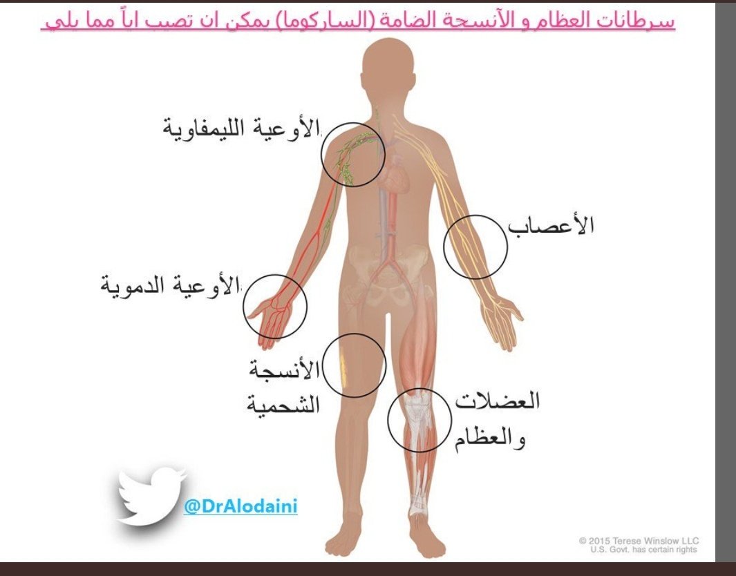 العظام ساركوما ساركوما العظام: