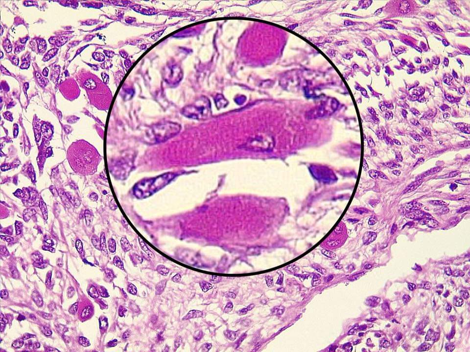 Van-Hung Nguyen, MD FRCPC 🇺 🇦 🌻 on Twitter: "DDx Monophasic Wilms T...