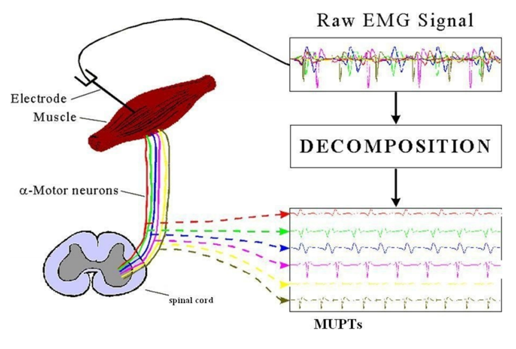 [6/27]Yes! EMG signals are the summation of the action potentials of active motor units (MUs), and different MUs have different waveforms which can be identified.Via invasive intramuscular EMG 