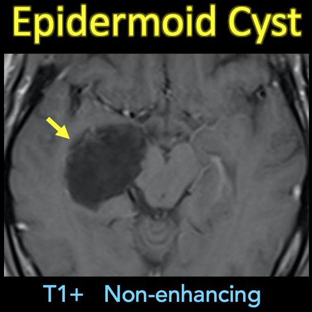 John O'Keefe (@johnjokeefemd) on Twitter photo Epidermoid Cyst
Young male (early 30s) w/ seizures
T2: Isointense to CSF
FLAIR: Heterogeneous āDirtyā Signal
DWI: Restricted diffusion
T1+: No enhancement
#neurorad #neuro #radres #meded #foamrad #neurology
<a href="/RyanBPetersonMD/">Ryan B Peterson šøšŖ</a> <a href="/GelarehSadigh/">Gelareh Sadigh, MD</a> Epidermoid Cyst
Young male (early 30s) w/ seizures
T2: Isointense to CSF
FLAIR: Heterogeneous āDirtyā Signal
DWI: Restricted diffusion
T1+: No enhancement
#neurorad #neuro #radres #meded #foamrad #neurology
<a href="/RyanBPetersonMD/">Ryan B Peterson šøšŖ</a> <a href="/GelarehSadigh/">Gelareh Sadigh, MD</a>