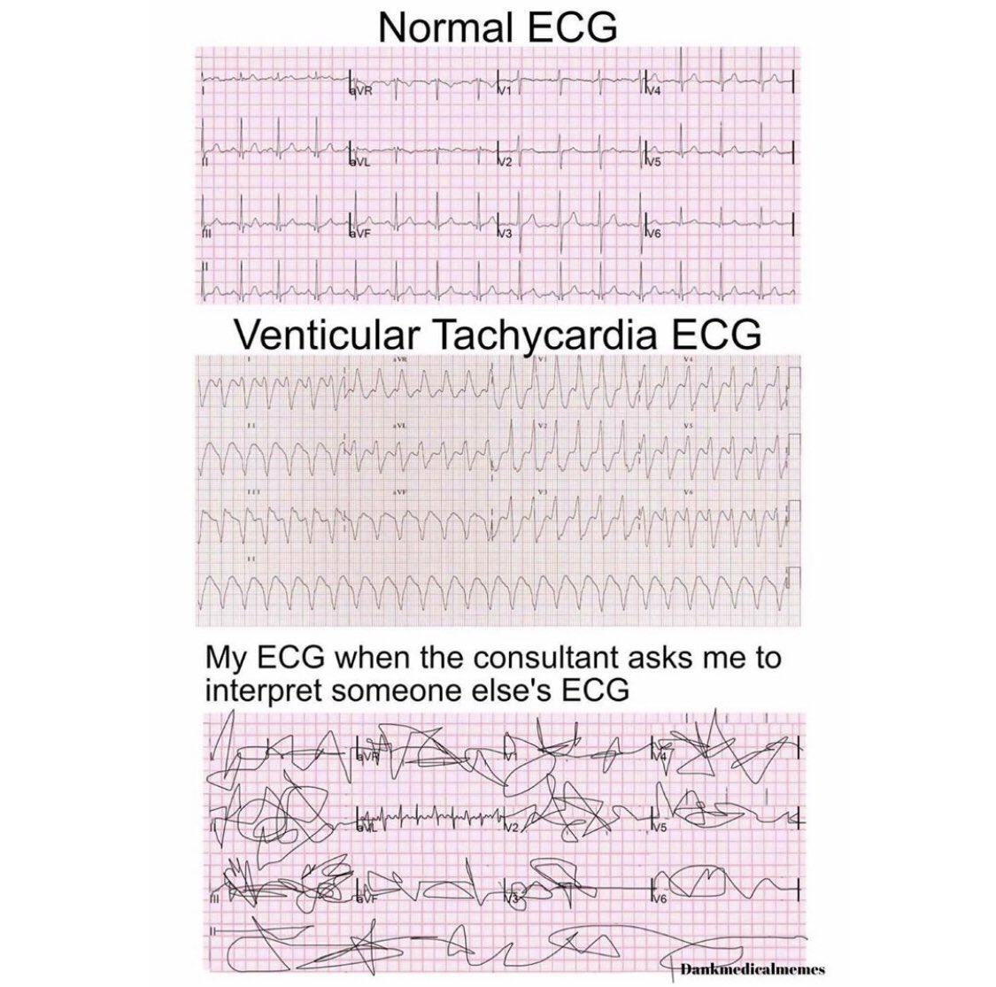 Let’s call it Mobitz type 3 and call it a day yh? #MedTwitter #medicalstudent