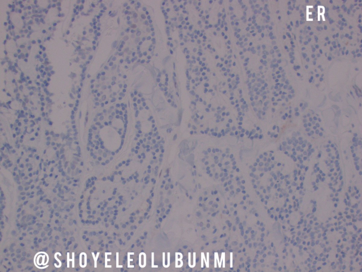 ShoyeleOlubunmi's tweet photo. #PathPourri Case 1 Immunostains https://t.co/MYrDjFmKgq