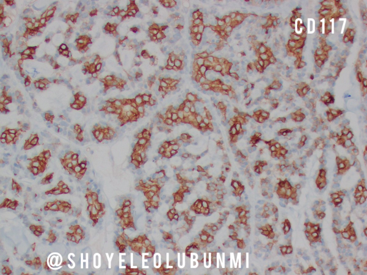 ShoyeleOlubunmi's tweet photo. #PathPourri Case 1 Immunostains https://t.co/MYrDjFmKgq