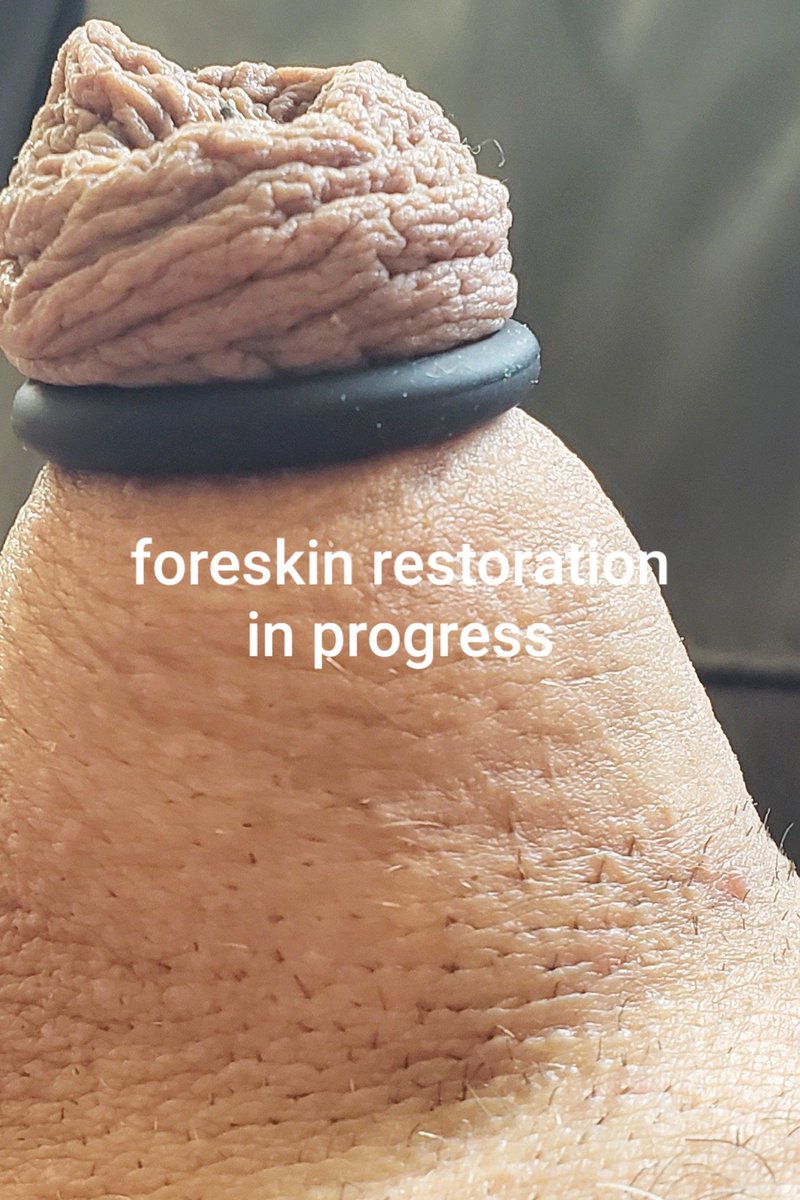 jizz_jon's tweet photo. Long process 
#foreskinrestoration #cut #uncut #cock #foreskin https://t.co/IrnWmwg5Xo