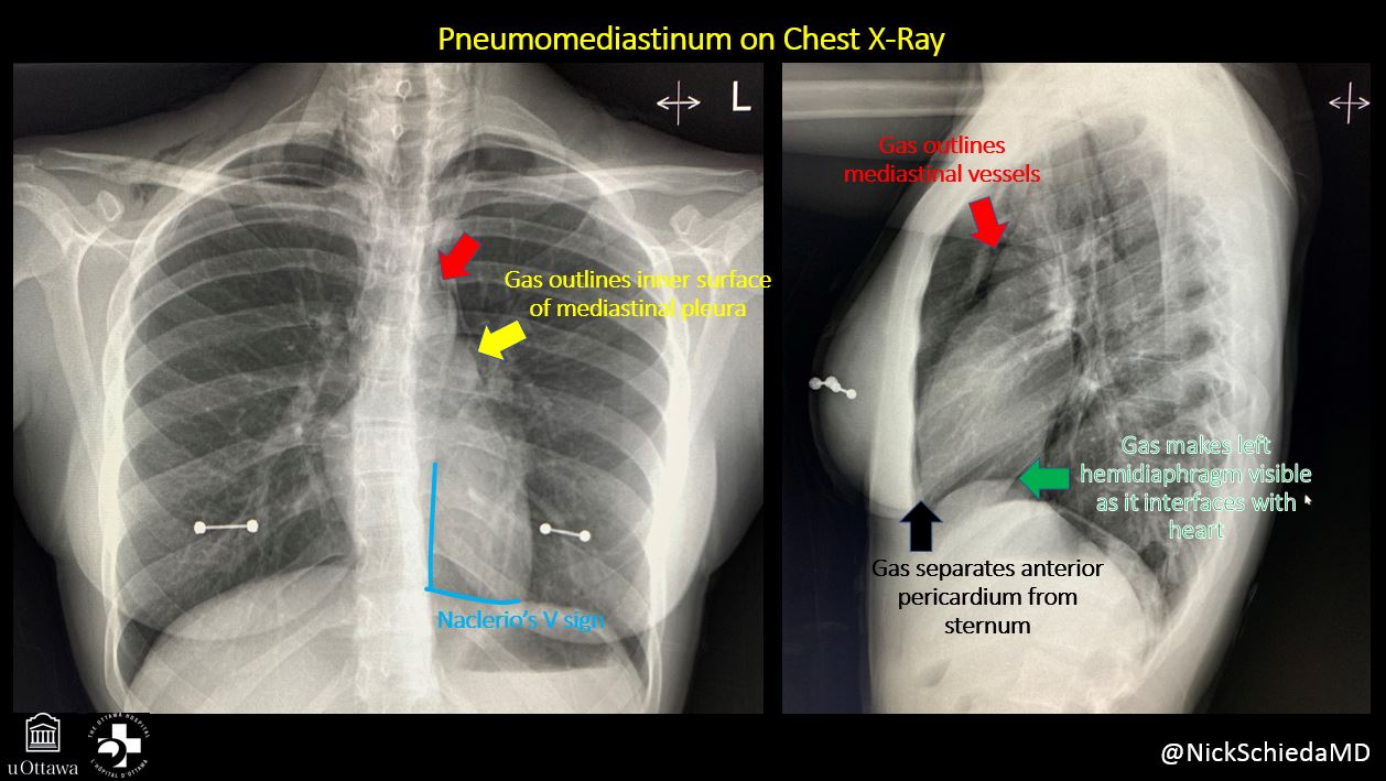 NickSchieda on Twitter "Hx Vomiting + chest pain Dx