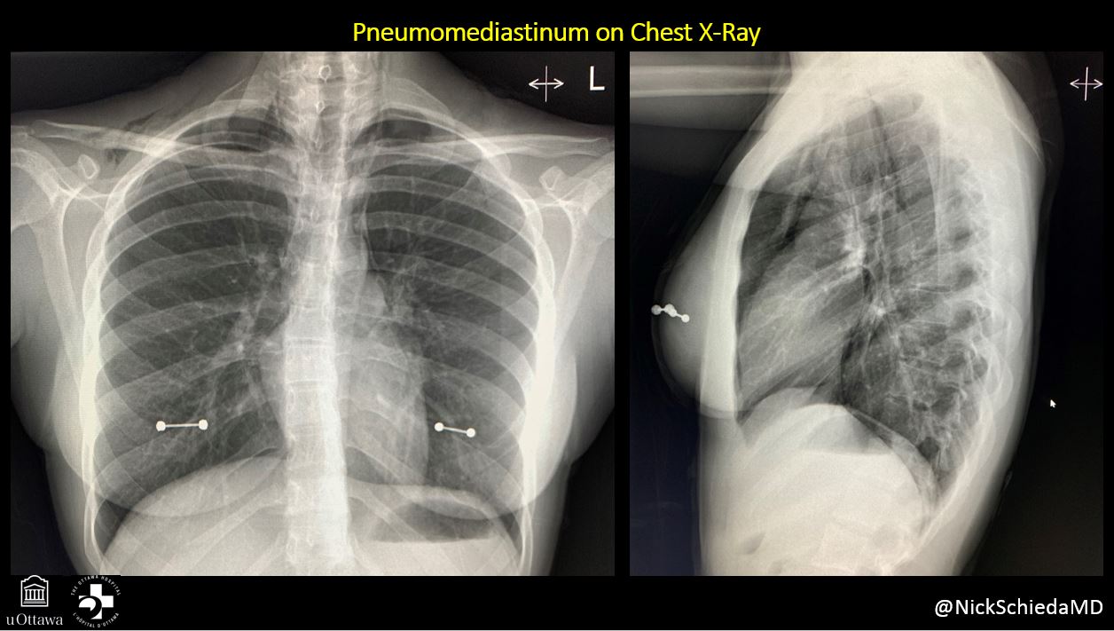 NickSchieda on Twitter "Hx Vomiting + chest pain Dx