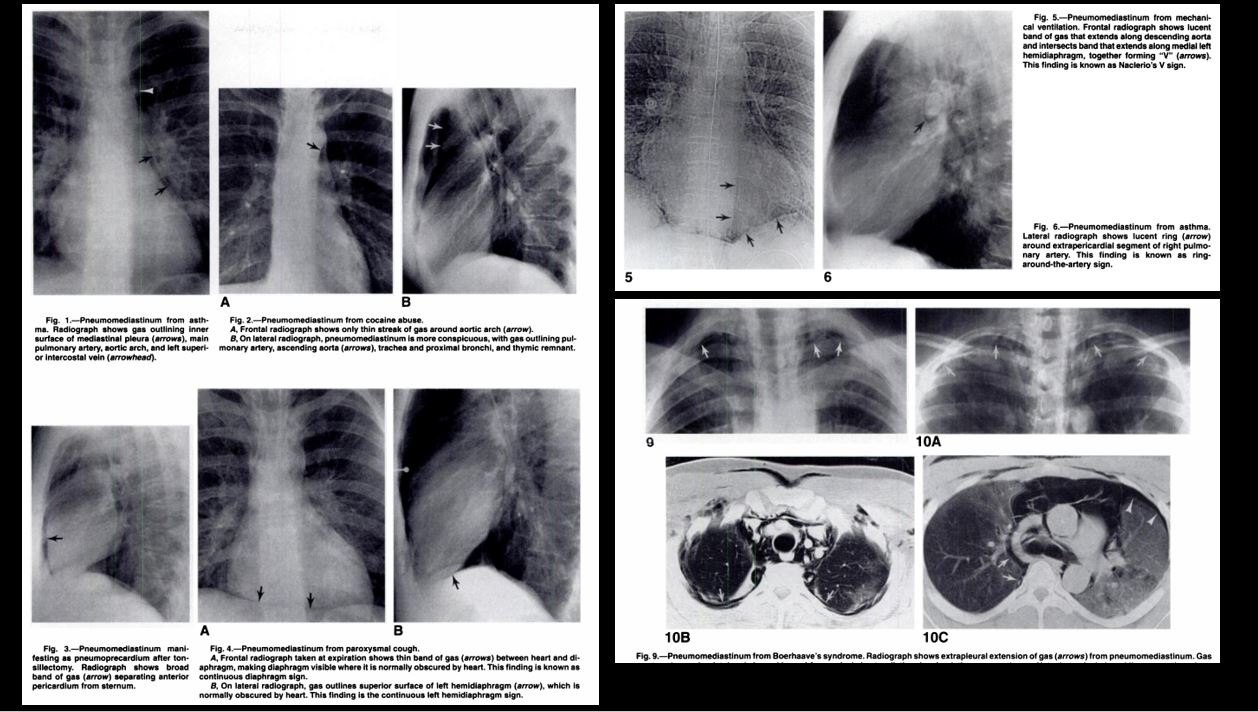 NickSchieda on Twitter "Hx Vomiting + chest painNNDx