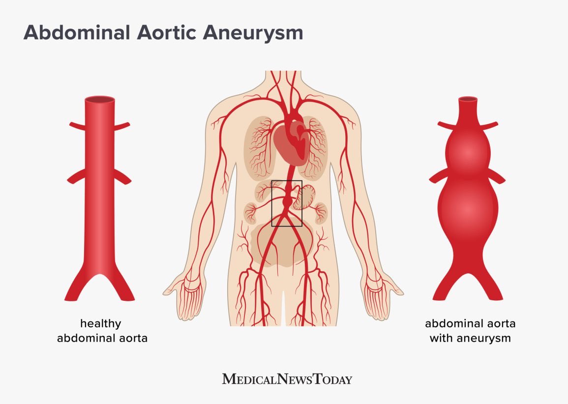 Dieta para estenosis aortica