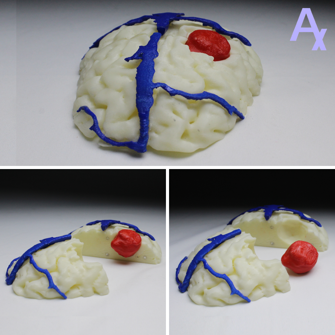 Anatomiz3D's tweet photo. The tumour was observed in the dura leading to suppression of the frontal lobe. To understand the defect, orientation and planning of the corrective surgery procedure, the medical team utilised this 3D printed anatomy.

#Healthcare #3DPrinting #Medical3DPrinting #Anatomy https://t.co/fGB8IyPibX