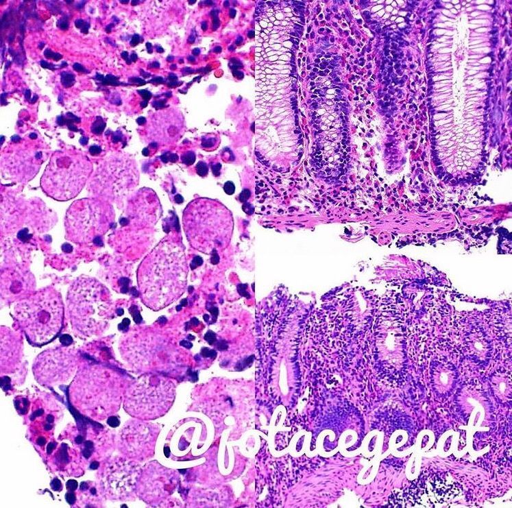 JMGardnerMD's tweet photo. Amoebic colitis. Amoebas remind me of big histiocytes w red dot in center. Easy to miss them! Pics: @JCGarcesPath #pathology #GIpath https://t.co/riUe5OCNdE