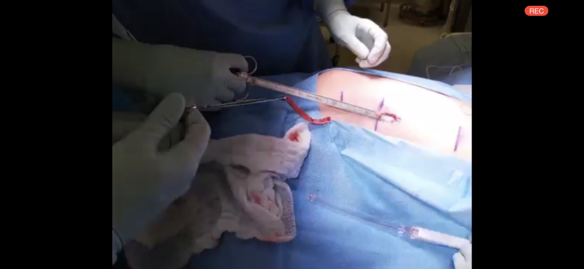 AngelaYuanMD's tweet photo. Fantastic video on fascia lata mid-urethral sling presented by my former @DartmouthHitch colleagues Dr. Kristen Gerjevic and Dr. Jonathan Shaw. Well done! @GynSurgery #SGS2020 https://t.co/GHYmOoLg6o